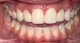 After Image: Veneers - front