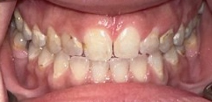 Before Image: Veneers - front