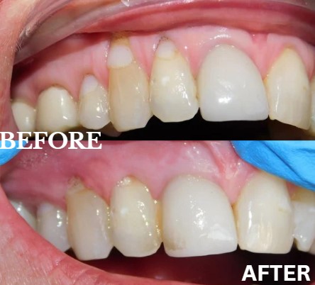 Before and After Image: Pinhole - right-front-oblique