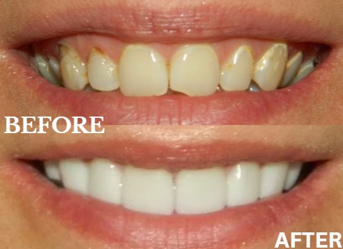 Before and After Image: Veneers - front