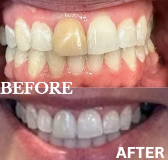 Before and After Image: Veneers - front