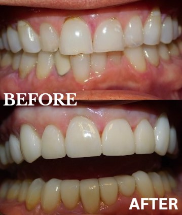 Before and After Image: Veneers - front
