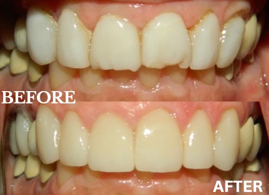 Before and After Image: Veneers - front