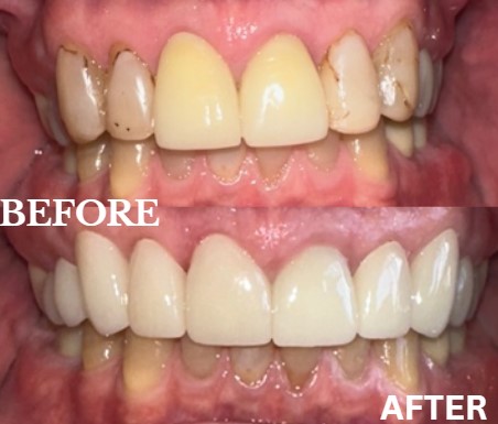 Before and After Image: Veneers - front