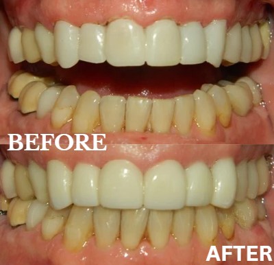 Before and After Image: Veneers - front