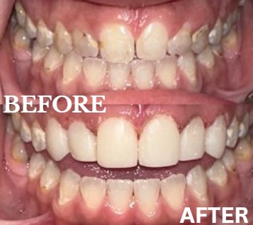 Before and After Image: Veneers - front