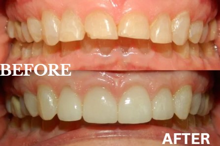 Before and After Image: Veneers - front