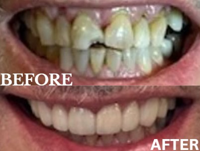 Before and After Image: Veneers - front