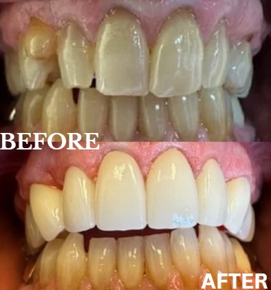 Before and After Image: Veneers - front