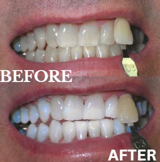 Before and After Image: Zoom Whitening - front