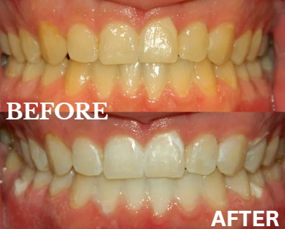 Before and After Image: Zoom Whitening - front