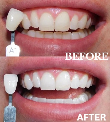 Before and After Image: Zoom Whitening - front