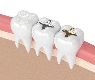 3D image of teeth, showing examples of a porcelain, silver, and gold dental filling.