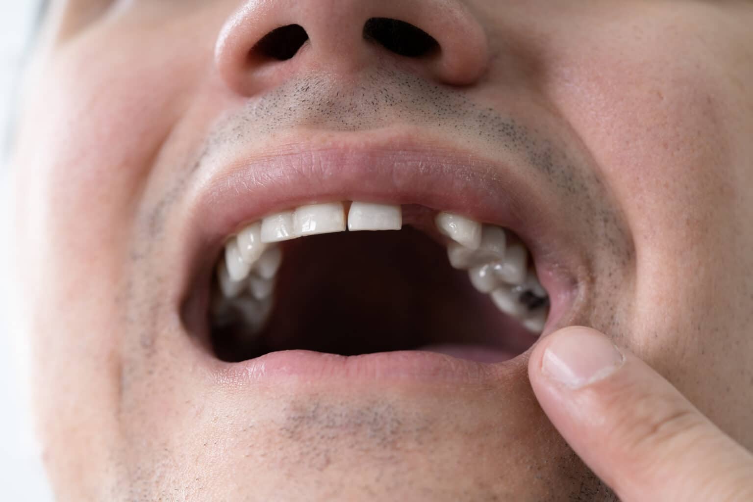 Close up of a patient pointing at the gap between their teeth where a tooth is missing, in need of a dental bridge.