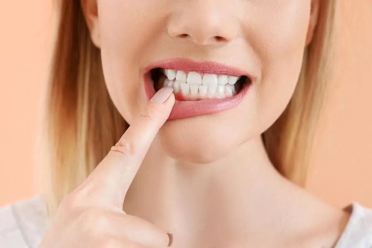 Close up of a woman's face with her lip pulled down to show her inflamed gums from gum disease.